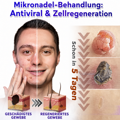 🫧🌟Celsiora® Multi-Functional Microneedle Hydrocolloid Patch Roll | Unterstützt die Pflege von Hautanhängseln, Warzen & hartnäckigen Hautunreinheiten