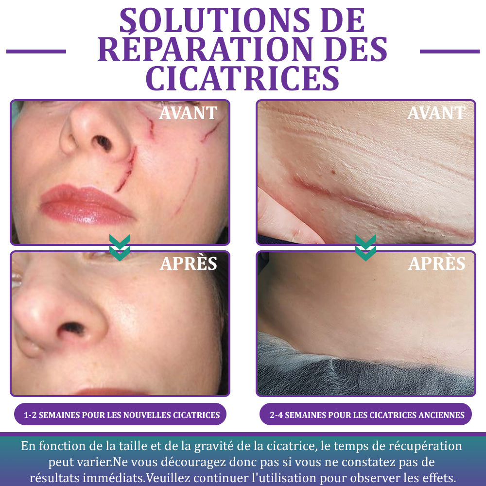 🏷️Boutique officielle : Flysmus® ReGen Bandelette Microneedle Nano à l’acide hyaluronique — Traitement efficace des cicatrices anciennes et récentes, cicatrices chirurgicales, vergetures, chéloïdes, acné, brûlures, verrues, dermatomes et varices