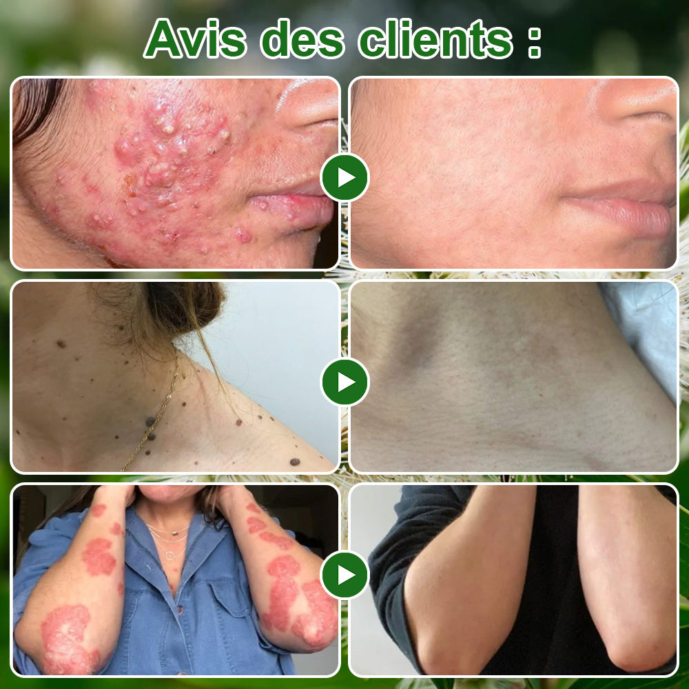 🌿𝐳𝐯𝐨𝐞𝐯𝐨® 𝐂𝐫𝐞̀𝐦𝐞 𝐝𝐞 𝐓𝐫𝐚𝐢𝐭𝐞𝐦𝐞𝐧𝐭 𝐚̀ 𝐥’𝐇𝐮𝐢𝐥𝐞 𝐝’𝐀𝐫𝐛𝐫𝐞 𝐚̀ 𝐓𝐡𝐞́ – Testée dermatologiquement et certifiée par des dermatologues. Une aide efficace contre les taches cutanées, les dommages de la peau, le teint irrégulier et les signes du vieillissement.