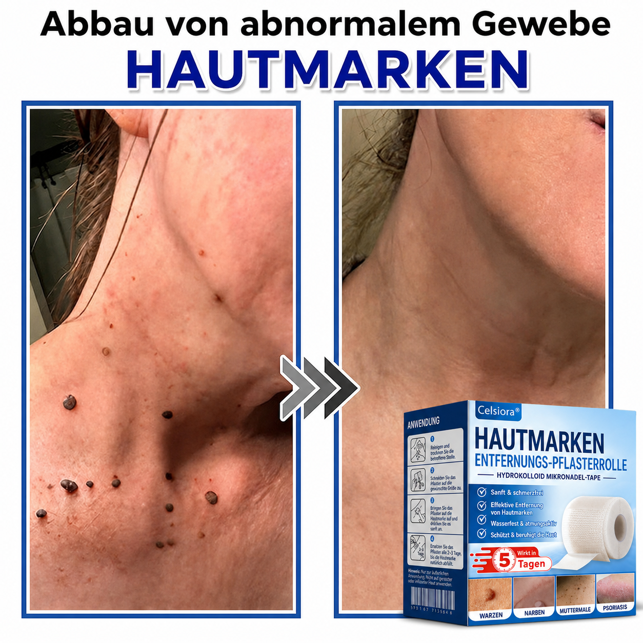 🫧🌟Celsiora® Multi-Functional Microneedle Hydrocolloid Patch Roll | Unterstützt die Pflege von Hautanhängseln, Warzen & hartnäckigen Hautunreinheiten