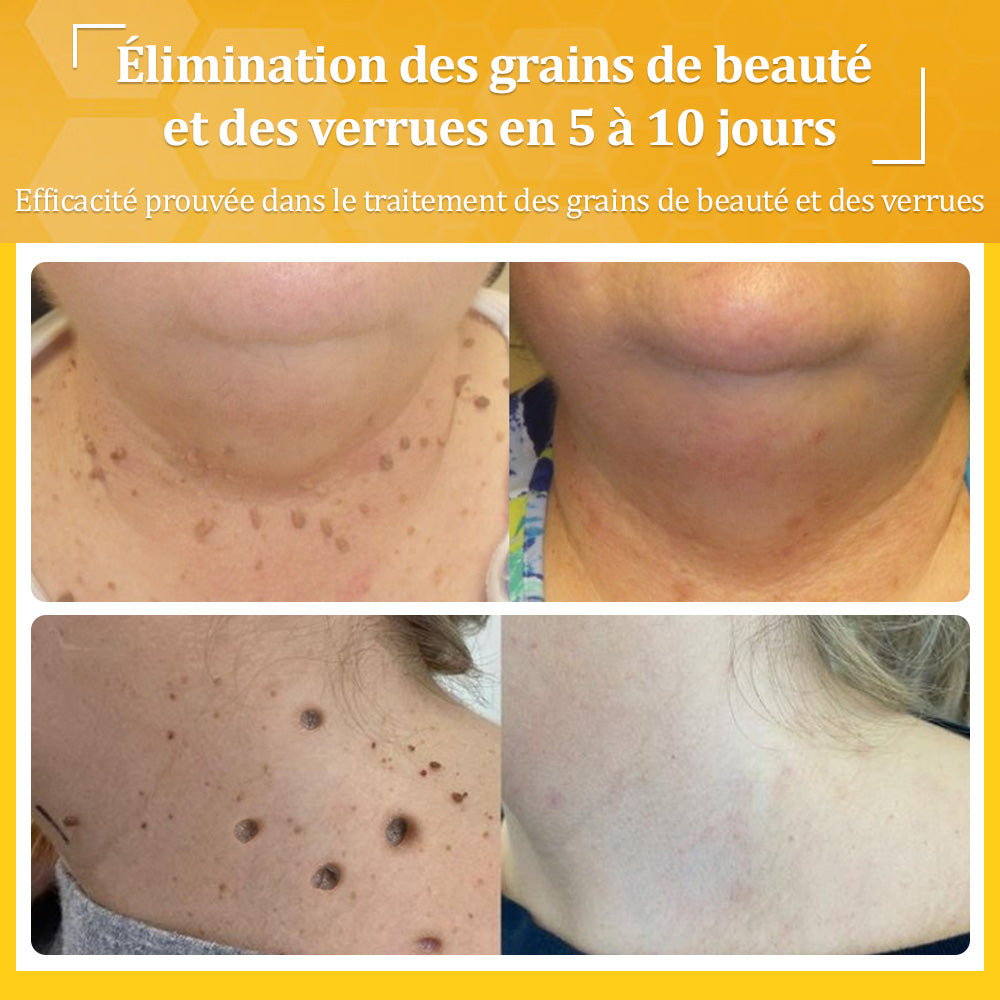 ✅flysmus® Crème au Venin d’Abeille – Dermatologiquement testée et recommandée par des dermatologues, traitement efficace des verrues, nodules et cicatrices.