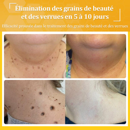 ✅flysmus® Crème au Venin d’Abeille – Dermatologiquement testée et recommandée par des dermatologues, traitement efficace des verrues, nodules et cicatrices.