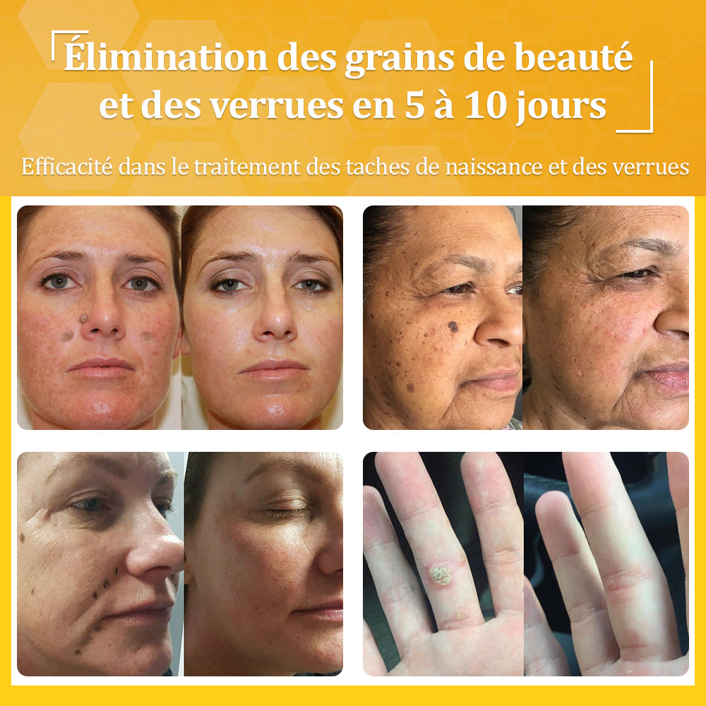 ✅flysmus® Crème au Venin d’Abeille – Dermatologiquement testée et recommandée par des dermatologues, traitement efficace des verrues, nodules et cicatrices.