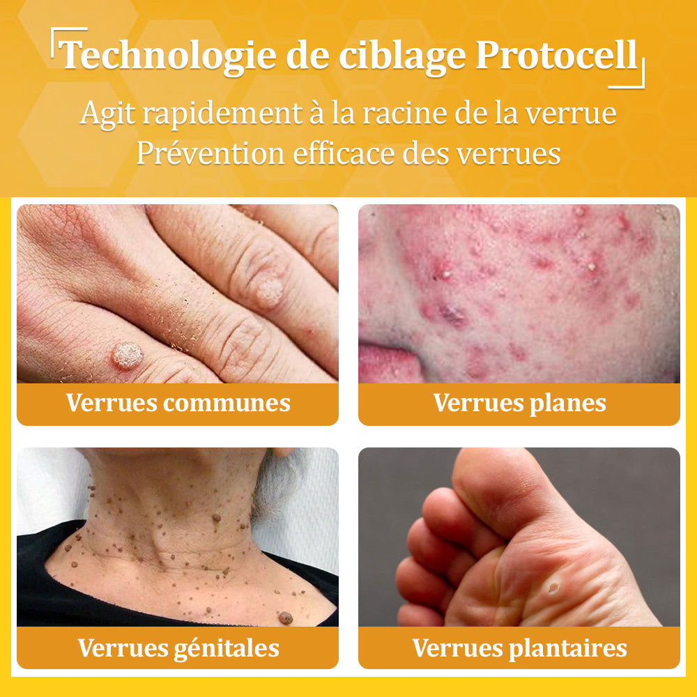 ✅flysmus® Crème au Venin d’Abeille – Dermatologiquement testée et recommandée par des dermatologues, traitement efficace des verrues, nodules et cicatrices.