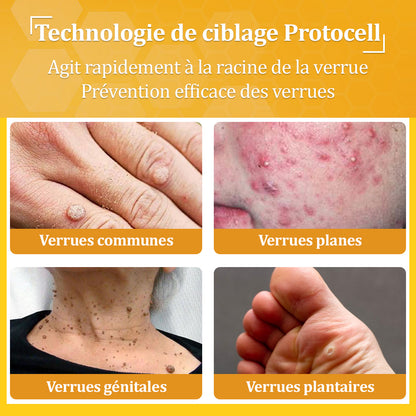 ✅flysmus® Crème au Venin d’Abeille – Dermatologiquement testée et recommandée par des dermatologues, traitement efficace des verrues, nodules et cicatrices.