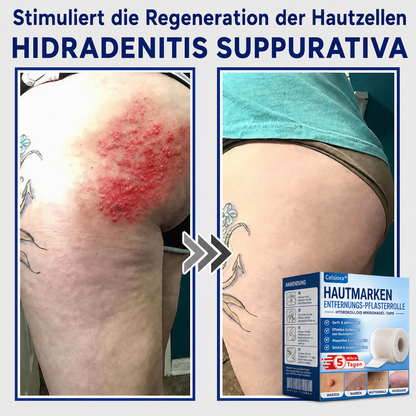 🫧🌟Celsiora® Multi-Functional Microneedle Hydrocolloid Patch Roll | Unterstützt die Pflege von Hautanhängseln, Warzen & hartnäckigen Hautunreinheiten
